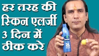 स्किन एलर्जी का घरेलू नुस्खा How To Cure Skin Allergy  skin allergy treatment at home Sachin Goyal [upl. by Devan]