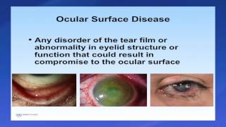 Introduction to Scleral Lenses [upl. by Arianne]