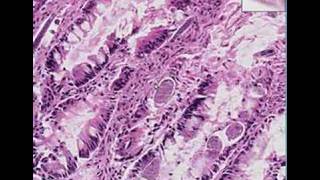 Histopathology Small intestine ileumStrongyloides enterit [upl. by Cash]