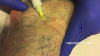 Sclerotherapy highlights [upl. by Gosnell]