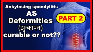 How to cure Ankylosing spondylitis [upl. by Carlin]