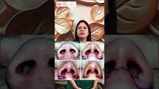 Alar base reduction surgery  Dr Ekta Mishra Gautam  GBL Hospitsl Indore [upl. by Hendon672]