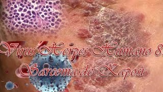 Virus Herpes Humano 8Sarcoma de Kaposi [upl. by Ziza150]