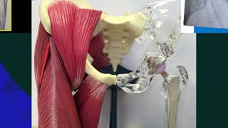 What is hip replacement Learn about arthritis surgery anterior approach and implant materials [upl. by Arais]