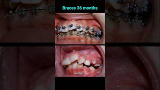 Fix buck and crooked teeth with 36 months braces orthodontist dentist braces [upl. by Novaelc]