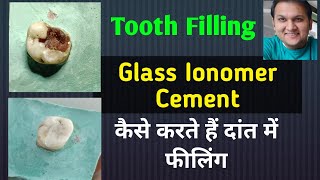 Tooth Filling Glass Ionomer Cement  GIC Restoration  GIC filling [upl. by Leummas]