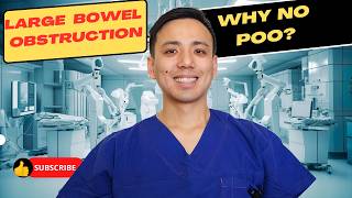 Large Bowel Obstruction Why can I not poo [upl. by Ruenhs24]