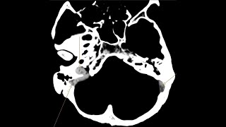 Venus Sinus Thrombosis and Intraventricular haemorrhage  CT CT angiogram and Venogram [upl. by Klockau]