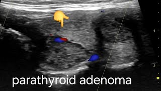 Large Parathyroid adenoma ultrasound and color Doppler video [upl. by Etterrag865]