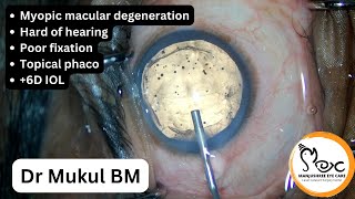 Myopic macular degen Topical phaco  6D IOL [upl. by Nerra]