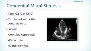 Mitral Stenosis Basics [upl. by Skylar299]