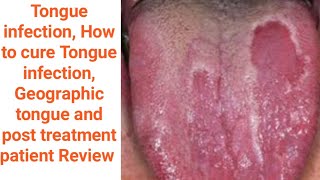 Geographic tongue Tongue infection Mouth inside infection benign migratory glossitis causes amp Tt [upl. by Ainoloppa]