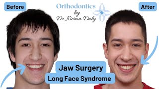 Long Face Syndrome  Jaw Surgery [upl. by Leahcimauhsoj]