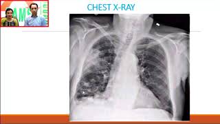 DAMS Medicine Unplugged Nocardia CXR [upl. by Jelena]