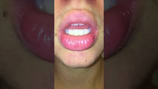 exfoliative cheilitis  day 0 pre treatment  tacrolimus amp burts bees wax hand salve [upl. by Sosthena]