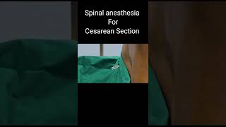 Spinal Anesthesia in Cesarean  OT stories  YouTubeShorts [upl. by Anairotciv]