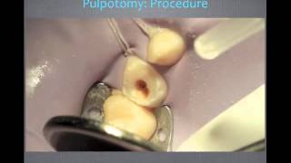 Pulp Therapy and Primary Tooth Pulpotomy  Video Review [upl. by Wolsniw]