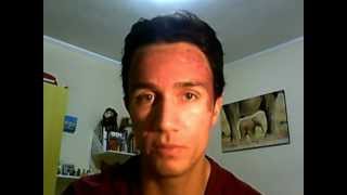 50 TCA Peel  The Results  Day 3  Trying to get rid of acne scars and melasma [upl. by Issak]