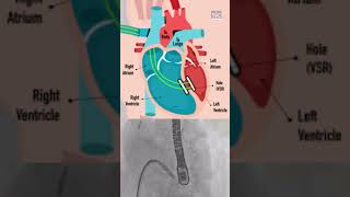 Ventricular Septal Rupture VSR  The Valve Clinic [upl. by Elleirol707]