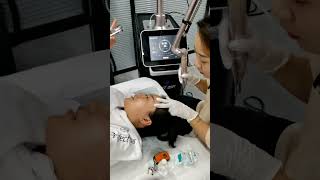 Picosecond laser eyebrow washdark removal beijingperfectlaser picolaser [upl. by Daune127]