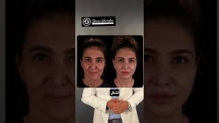 شد الشفايف العميق  Deep Plane Lip Lift ✨ drghoraba اكسبلور plasticsurgerydubai facelift [upl. by Eilyab]