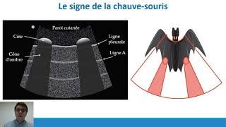 Elearning n°1  Echographie pleuropulmonaire dans la dyspnée aiguë  Thèse François M [upl. by Sim]