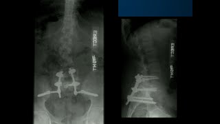 The Role of Reduction in Dysplastic Spondylolisthesis  Sigurd Berven MD [upl. by Notsehc]