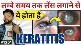 Keratitis Eye Infection Cause Symptoms amp Treatment In Hindi [upl. by Sucam]