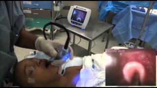 GlideScope Pediatric Airway Rounds Case Study 3 year old Umbilical Hernia Repair [upl. by Nelhsa]