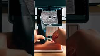 demo  transverse vs longtudinal usm nurse doctor vascularaccess ultrasoundiv [upl. by Pence221]