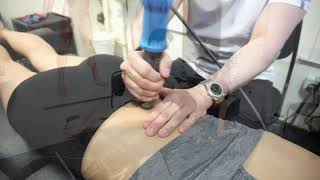 Shockwave Therapy for lower back pain [upl. by Enneiluj511]