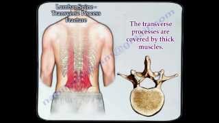 Lumbar Spine Transverse Process Fracture  Everything You Need To Know  Dr Nabil Ebraheim [upl. by Eenaj]