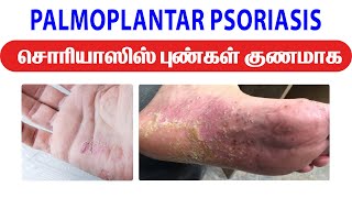 PALMOPLANTAR PSORIASIS சொரியாஸிஸ் புண்கள் குணமாக  Psoriasis Remedy  JKT SKIN psoriasis remedies [upl. by Kiki]