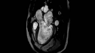 Aortic Regurgitation  Threechamber cine SSFP MR [upl. by Glynda]