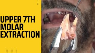 Upper 2nd Molar Extraction [upl. by Ilam]