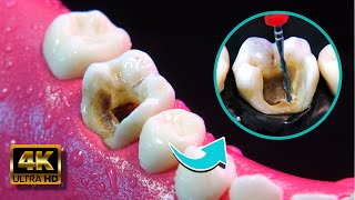 Restauración dental Prepárate para Sorprenderte 4K [upl. by Ahcsap]