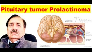 Prolactinoma Signs Symptoms diagnosis and Treatment Lectures by Dr Alamzeb [upl. by Silvanus]