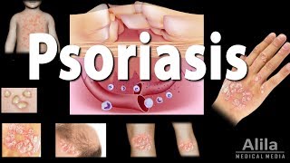 Psoriasis Types Symptoms Causes Pathology and Treatment Animation [upl. by Boar]