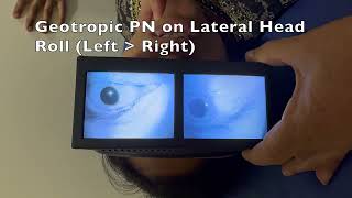 Left Sided Geotropic Horizontal Canal BPPV [upl. by Hardman755]