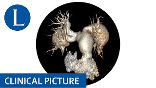 Recurrent pulmonary emboli with aneurysms think vasculitis and Hughes Stovin syndrome [upl. by Moscow335]