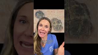 Have you seen these common skin lesions 🎥AUSTIN SKIN DOCS seborrheickeratosis dermatology [upl. by Trinette]