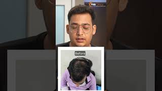 PRP Hair Therapy Results  See the Transformation at PHS Clinics [upl. by Axe]