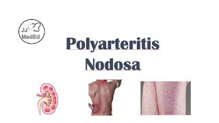 Polyarteritis Nodosa PAN  Signs amp Symptoms Diagnosis Treatment [upl. by Dnaletak]