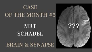 Case of the month 5 ❤️ Fall des Monats I Neuroradiologie I Brain amp Synapse [upl. by Caiaphas]