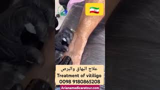 تمويه بقع البهاق والبرصTreatment of vitiligo [upl. by Orelie498]