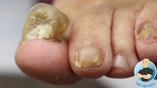 CUTTING PAINFUL SUPER THICK TOENAILS THAT SHE HID FROM HER FAMILY [upl. by Akimak]