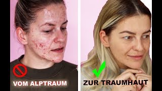 ❗️ In NUR 3 Monaten zur TRAUMHAUT  HEFTIGES Ergebnis ❗️ Microneedling Vorher Nachher Diana Delo [upl. by Nnaharas]