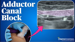 Adductor Canal Block 2024 update [upl. by Dareen]