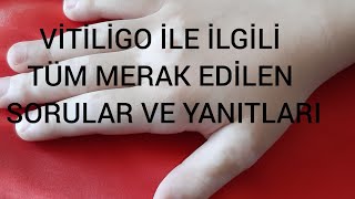 Vitiligo İçin Doktorumuz Hangi Tedaviyi Uyguladı Sonuç Ne Oldu Doğal Yöntemler İşe Yarıyor mu [upl. by Nueovas]