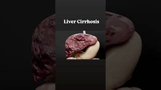 Understanding Liver Cirrhosis Symptoms livercirrhosisliverdisease liverdamageshorts [upl. by Llerraf]